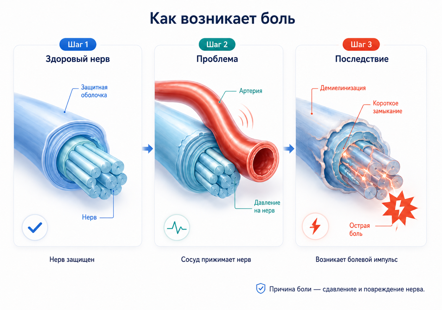 Пошаговая схема возникновения боли: как сосуд сдавливает тройничный нерв и разрушает защитную оболочку 