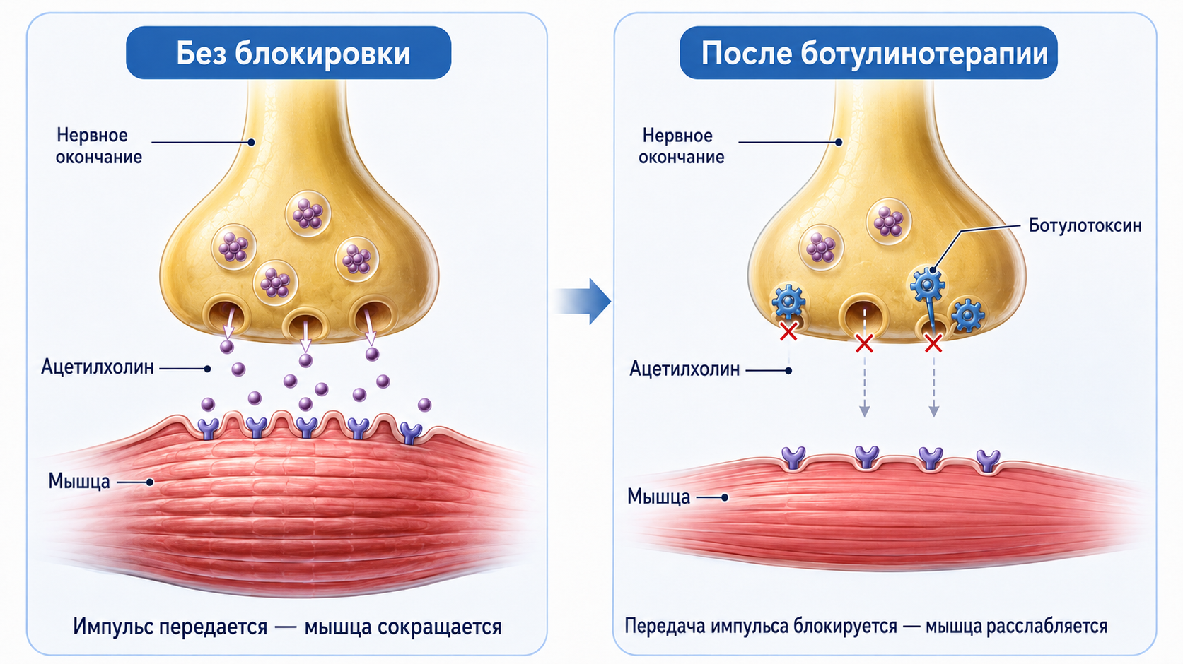 Схема блокировки нервных импульсов при ботулинотерапии